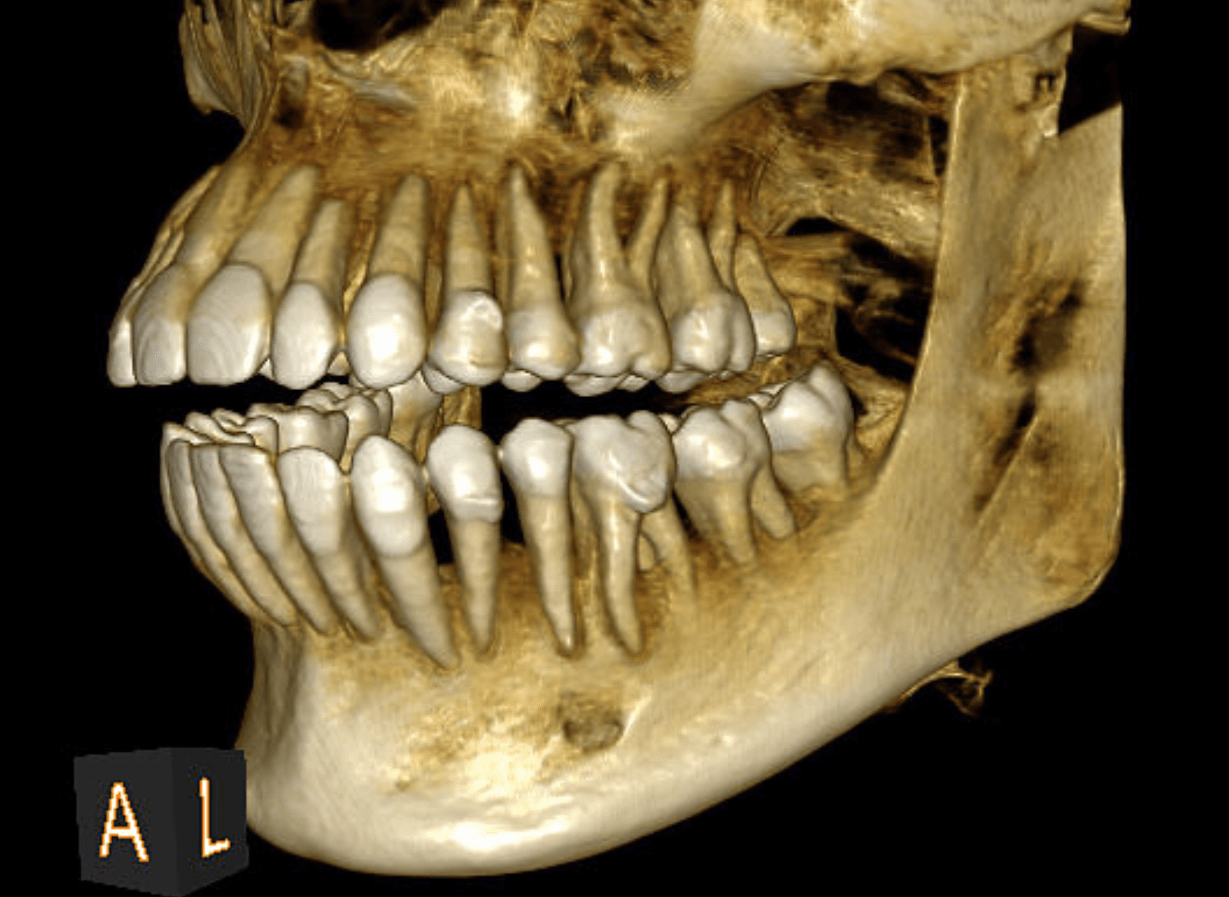 Αξονική Τομογραφία Κωνικής Δέσμης (CBCT)